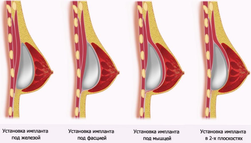 Увеличение груди - операция грудных желез